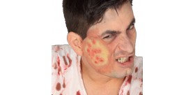 Cicatriz ampollas